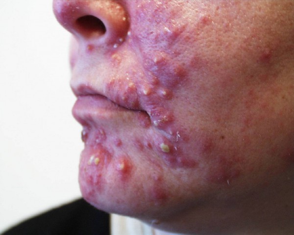acne-c10.jpg